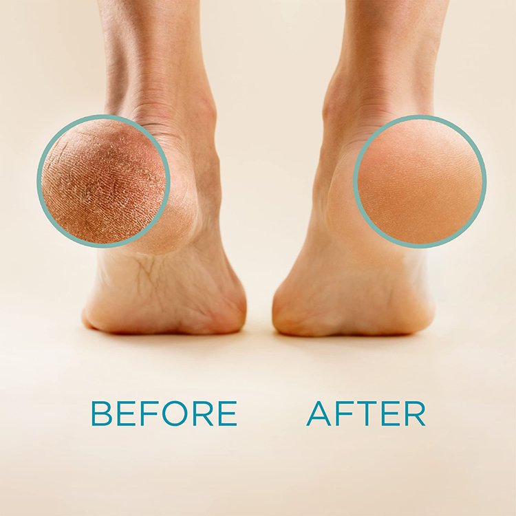 New Arrival Best Exfoliater Eliminating Rough Foot Heel Callus Remove Foot Exfoliating Gel
