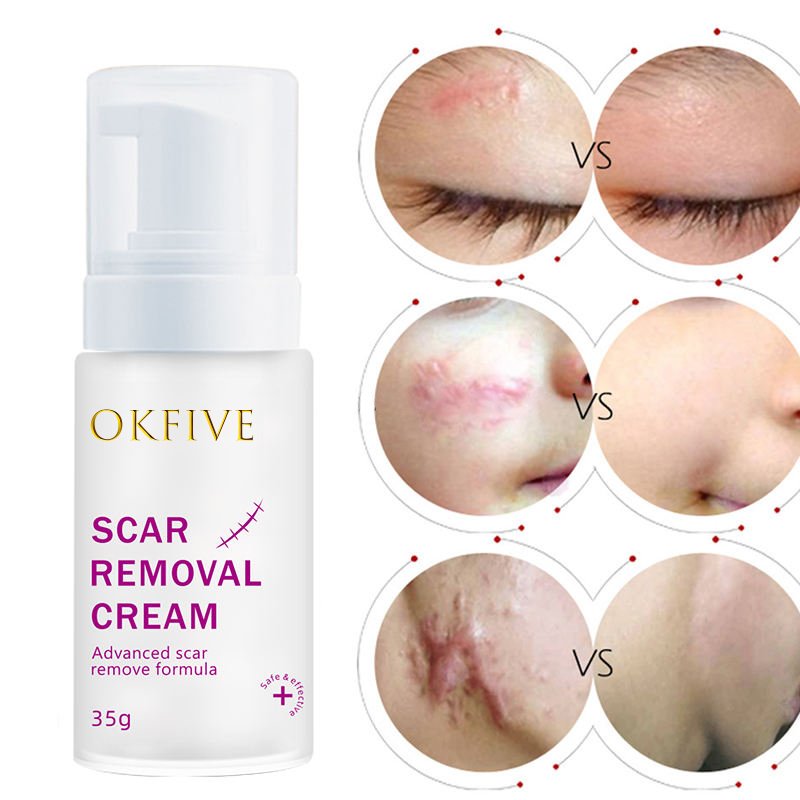 Self Owned Brand Waterproof And Quick Scar Repair Painless Removal Cream Strong Acne And Scar Removal Cream