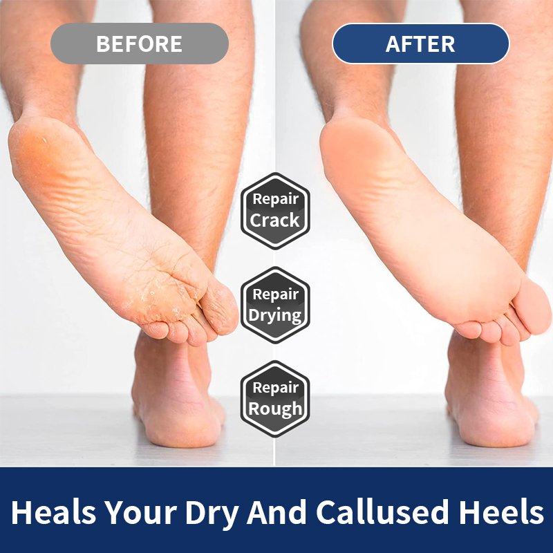 Deep repair of rough smooth soft heel helps prevent and heal hard dry cracked heels dead skin removal foot callus pain cream