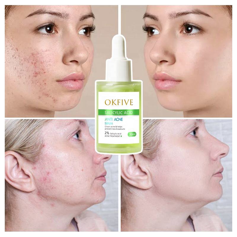 Anti Acne Serum Organic Vegen Facial Skin Care Soothing Salicylic Acid Oil Lightening Skin For Face Anti Acne Serum