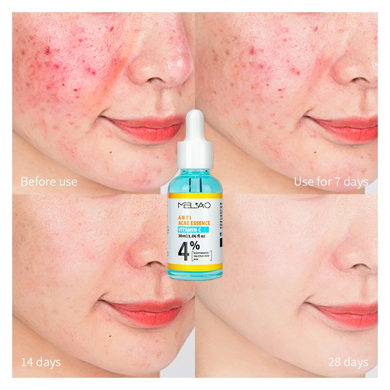 Natural Organic Acne Spot Treatment Pore Minimize Anti Acne Face Serum Acne Serum Salicylic Acid