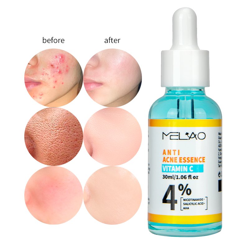 Natural Organic Acne Spot Treatment Pore Minimize Anti Acne Face Serum Acne Serum Salicylic Acid