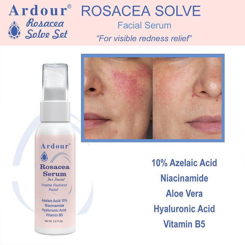 OEM skin care set ncludes Rosacea Cream, Serum and Moisturizing Face Wash Rosacea Solve Set Chamomile Extracts and Vitamin B5