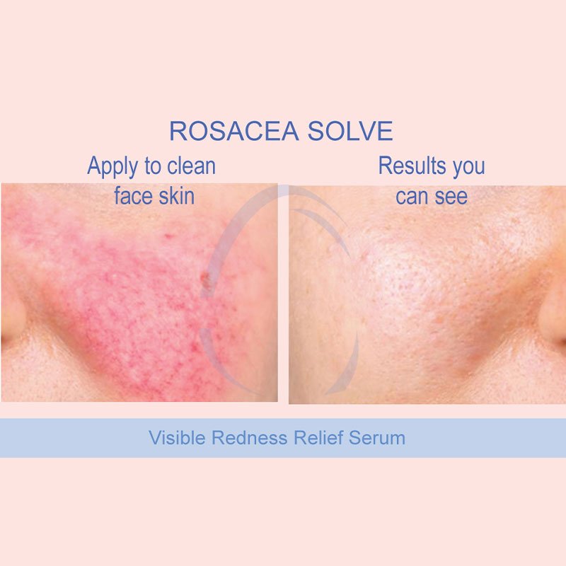 OEM skin care set ncludes Rosacea Cream, Serum and Moisturizing Face Wash Rosacea Solve Set Chamomile Extracts and Vitamin B5