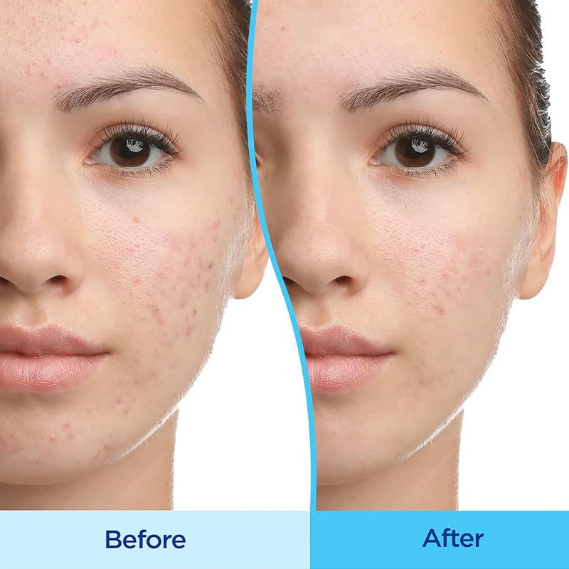 OEM Gentle Skin Care for Acne Prone Skin Day Gel & Night Moisturizer Set with Acne Treatment Gel and night moisturizer