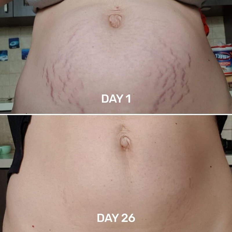 Private Label 120g Belly Firming Cream Body Moisturizing Repairing Stretch Marks Removal Cream Tummy Tuck Cream