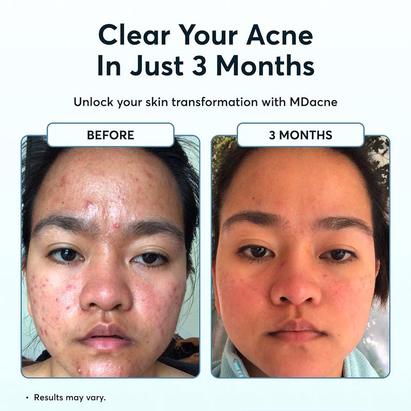OEM Acne treatment Sets for Adult & Teen Acne with Benzoyl Peroxide Cream Salicylic Acid Cleanser, Niacinamide Moisturizer