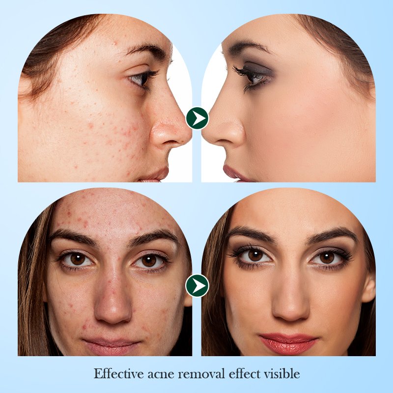 NEW 150g Wholesale Private Label Skin Care Anti Acne Oil Control Gentle Cleansing Tea Tree Bubble Cleanser clean mousse