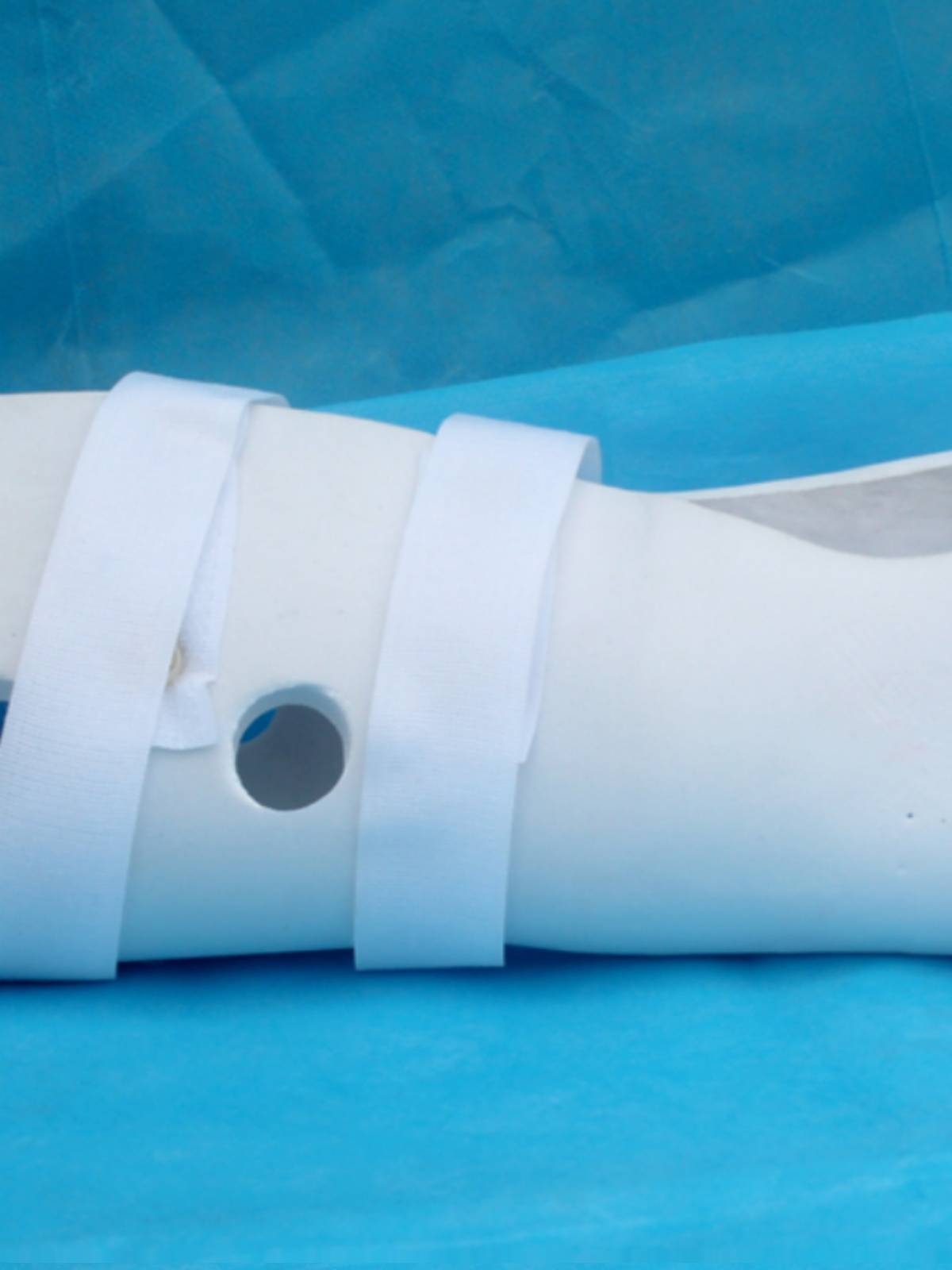 The high-molecular skeletal pelvis wrist sprained with a plaster for the front arm of the skeletal arm